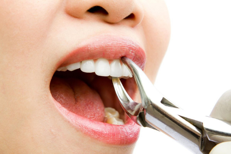 Tooth Decay Removal